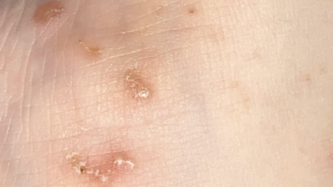 Cildimdeki bu kızarıklık ve kaşıntı uyuz belirtisi olabilir mi sizce?
