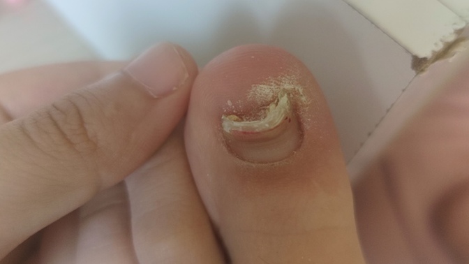 Yıllardır geçmeyen kalınlaşmış ayak tırnağım mantar mı, batık mı, cildiye mi ortopedi mi?