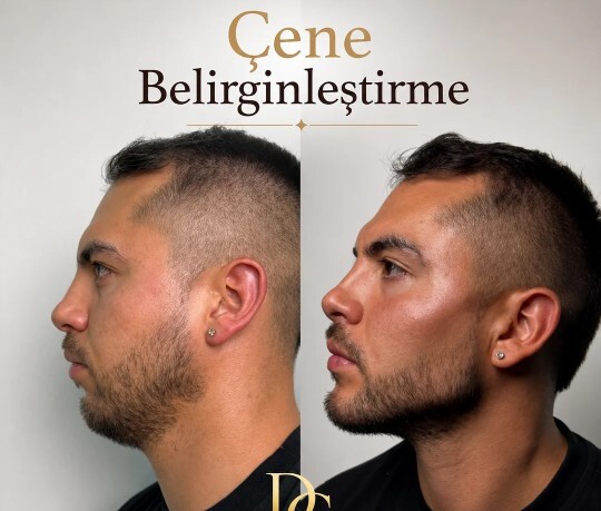 Erkeklerde estetiğe başladı, yakında tüm dünyada estetiksiz insan kalmayacak?
