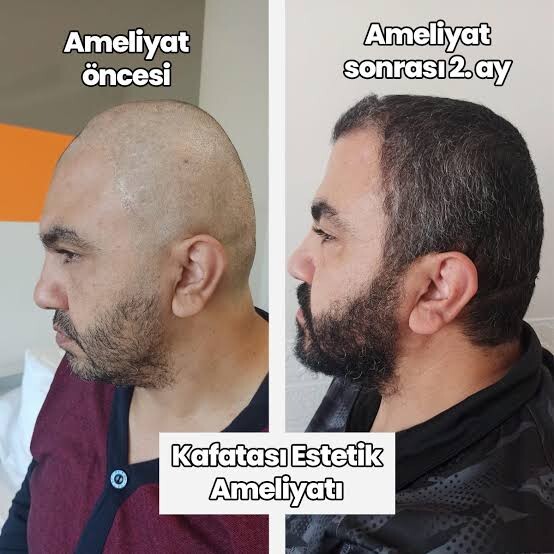 Erkeklerde estetiğe başladı, yakında tüm dünyada estetiksiz insan kalmayacak?