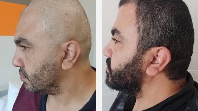 Erkeklerde estetiğe başladı, yakında tüm dünyada estetiksiz insan kalmayacak?