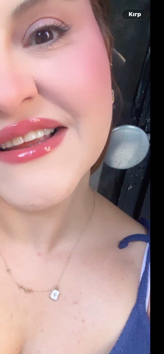 Dişlerim olmuş mu ya , bonding estetik dolgu yaptırdım?