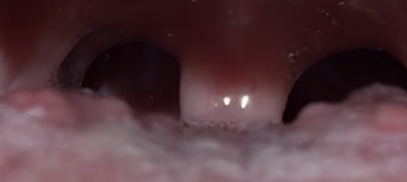 HPV sonrası dilde siğil gibi tomurcuklar normal mi, kendiliğinden geçer mi?