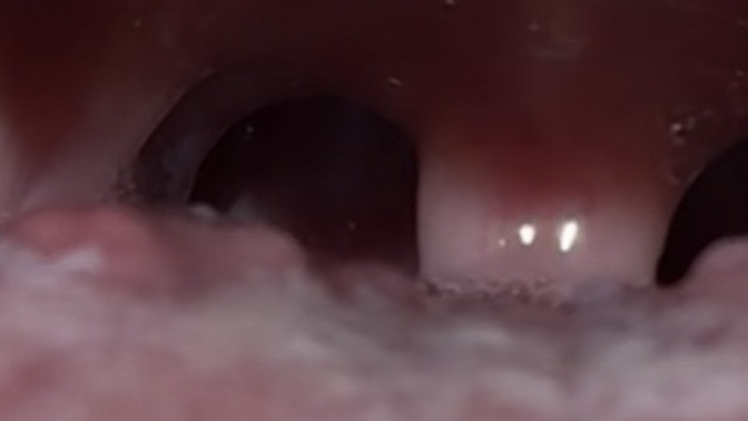 HPV sonrası dilde siğil gibi tomurcuklar normal mi, kendiliğinden geçer mi?