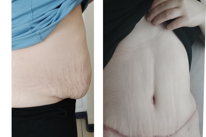 1 aylık abdominoplasti ve liposuction sonrası ödem ve izler ne zaman normale döner?