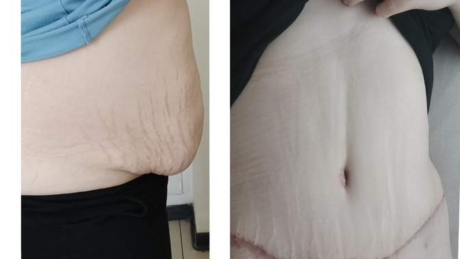 1 aylık abdominoplasti ve liposuction sonrası ödem ve izler ne zaman normale döner?