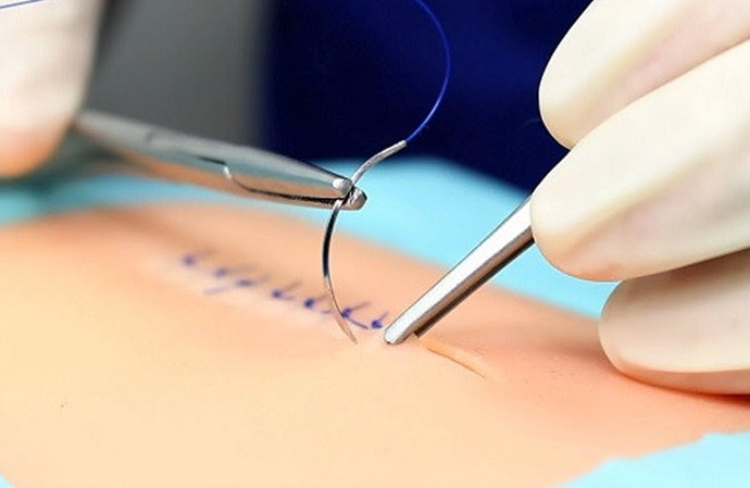 Hiç vücudunuza tıbbi sütur (dikiş) atıldı mı, hikayesi neydi?