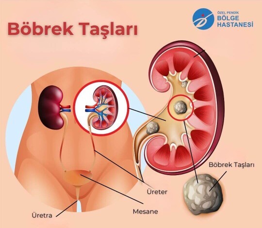 Böbrek taşı düşürdün mü?