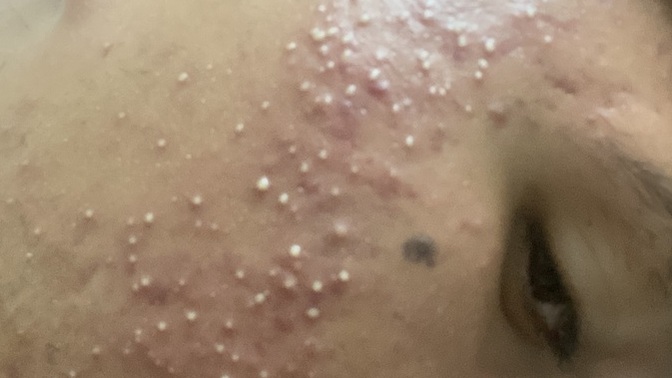 Yüzüm böyle şiş ve kızarık uyandım, aranızda cildiye uzmanı olan var mı?