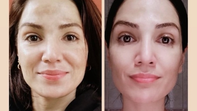 Yüz yogasi sizce gerçekten etkili mi, yapip sonuc alan var mi, botoks yaptiracaktim yine vazgectik bakalım🥴?