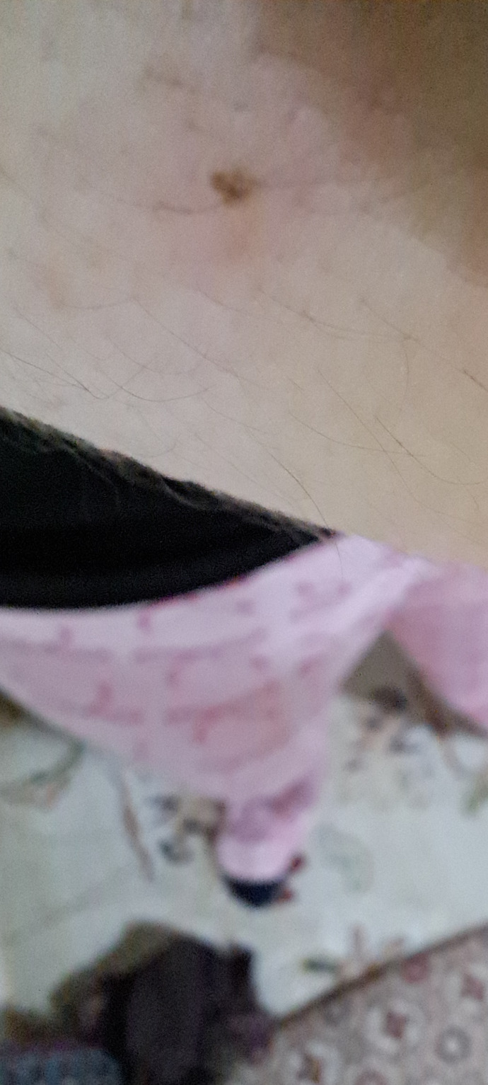 KKene ısırmasî mı?