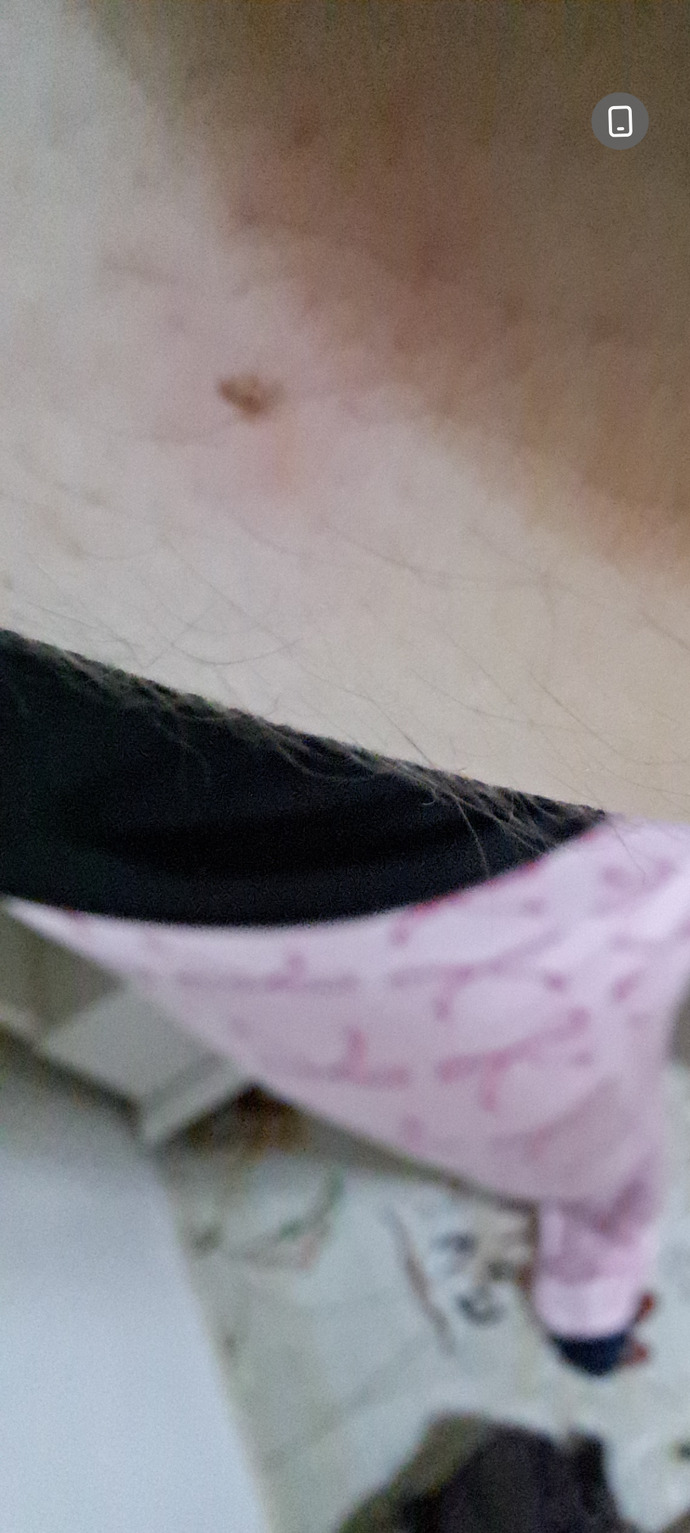 KKene ısırmasî mı?