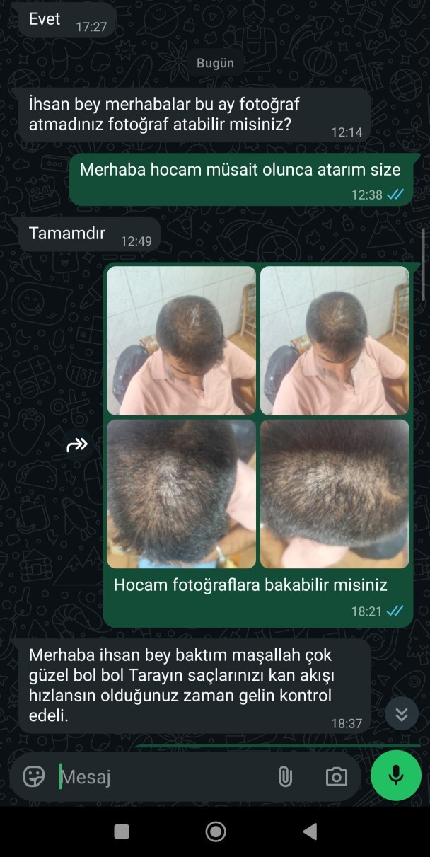 Ekim saç ekimi 7. ayda bu kadar seyrek olması normal mi, yoksa sorun mu var?