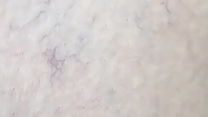 Neden bacağımda bu damarlar bu kadar belli oluyor?