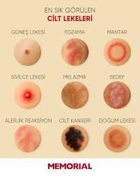 Vücudunuzda lekeler var mı?