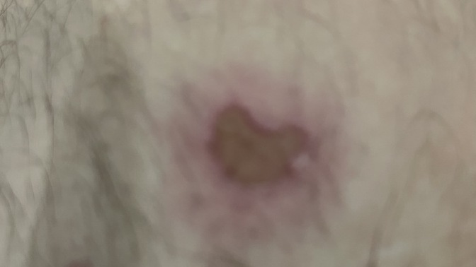 Sevgilim tartışırken sigarayı bacağıma bastı, iz kalp şeklinde çıktı, bu bir işaret mi yoksa tesadüf mü?