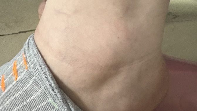 Ayak bileğine teneke zeytinyağı düştü, morarma ve uyuşma varken doktora gitmeli miyim?