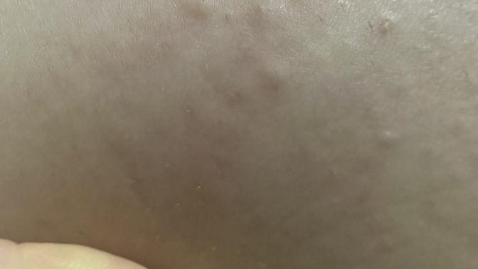 Bunlar böcek ısırığı mi?