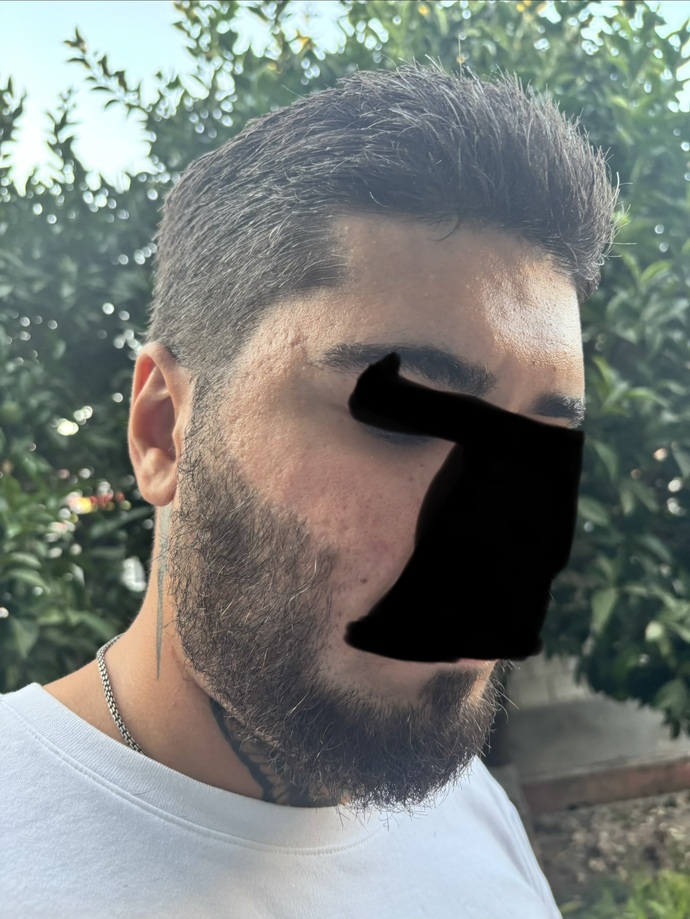 Kızlar, Lütfen objektif olun cildimde sivilce izi var dikkat çekiyor mu kötü mü?