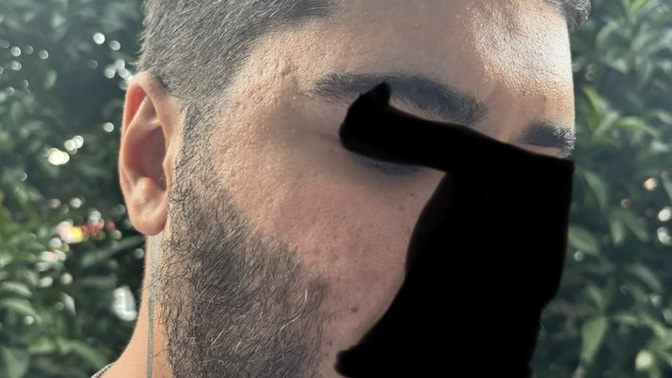Kızlar, Lütfen objektif olun cildimde sivilce izi var dikkat çekiyor mu kötü mü?