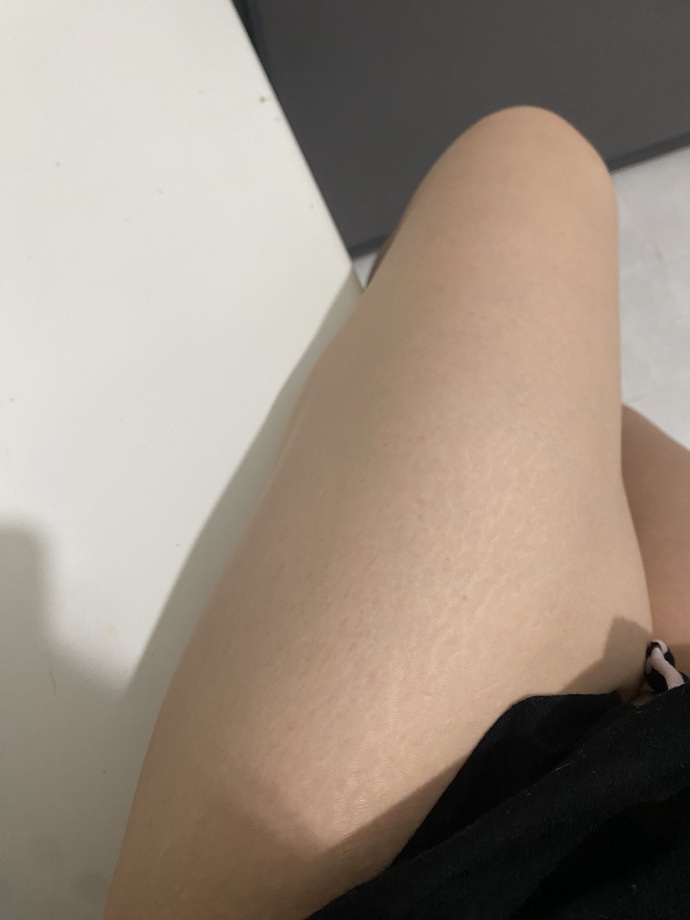 Bronzluk sevmiyorum açık tenli olduğum için çatlaklar çok daha belli oluyor çok mu çirkin bir görüntü çatlaklar