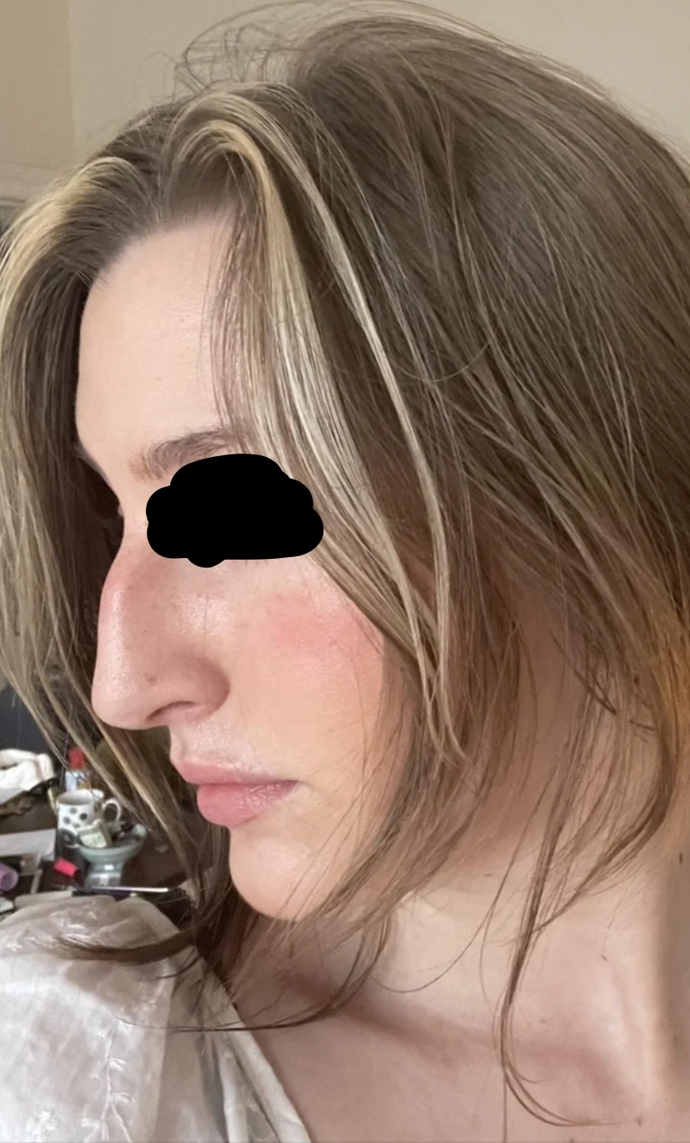 Burun estetiği olmalı mıyım, nasıl karar verebilirim ve nelere dikkat etmeliyim?