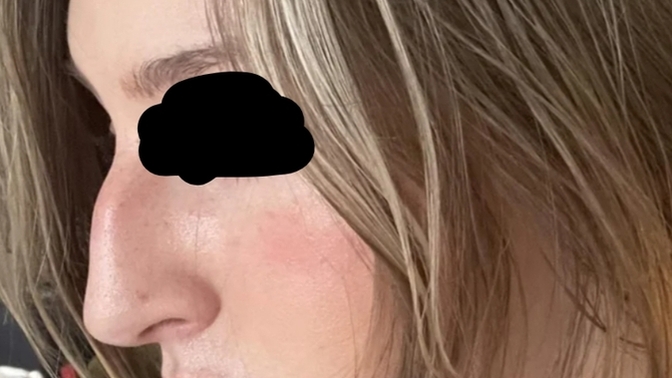 Burun estetiği olmalı mıyım, nasıl karar verebilirim ve nelere dikkat etmeliyim?