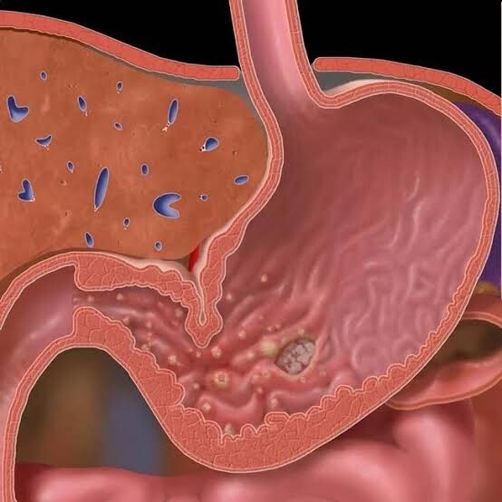 Gastrit sorununuz var mı?