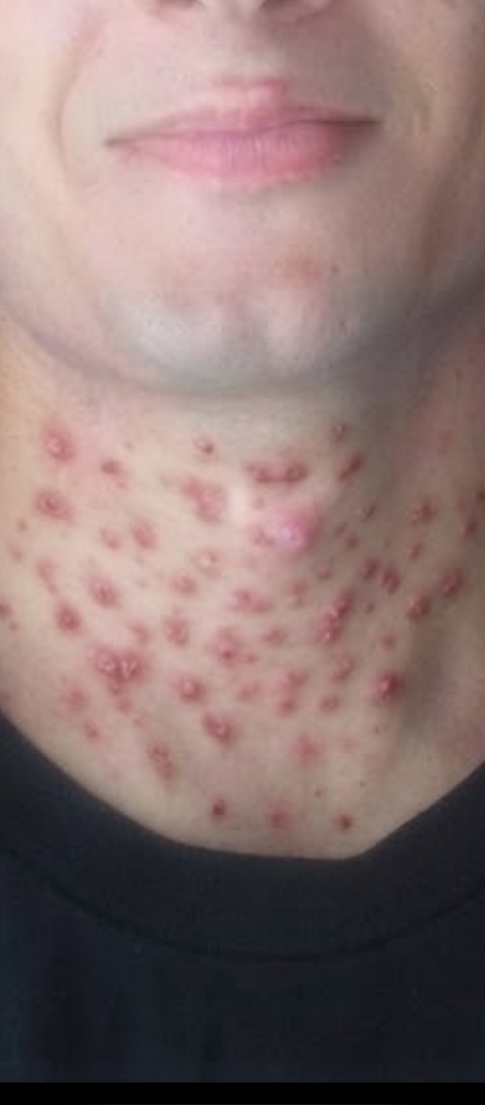 Diyete girdim boğazımda acayip sivilce çıktı normal mi?