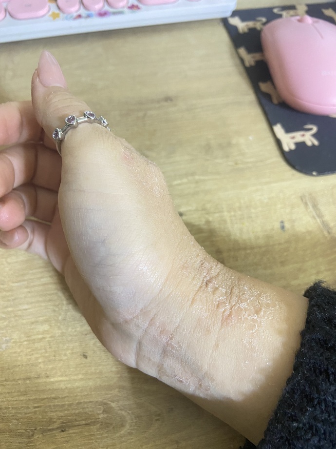 Üç krem denememe rağmen sürekli tekrarlayan egzama nasıl geçer?
