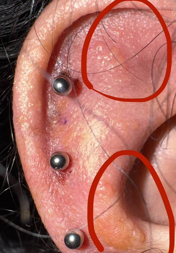 Piercing deldirdikten birkaç gün sonra kulakta kaşıntı ve kabarcıklar neden olur?