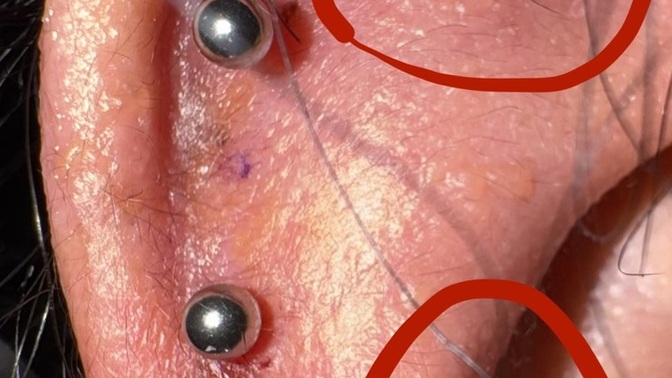 Piercing deldirdikten birkaç gün sonra kulakta kaşıntı ve kabarcıklar neden olur?