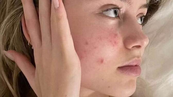 Sabah uyandığınızda yüzünüzde kocaman sivilce çıksa naparsınız?