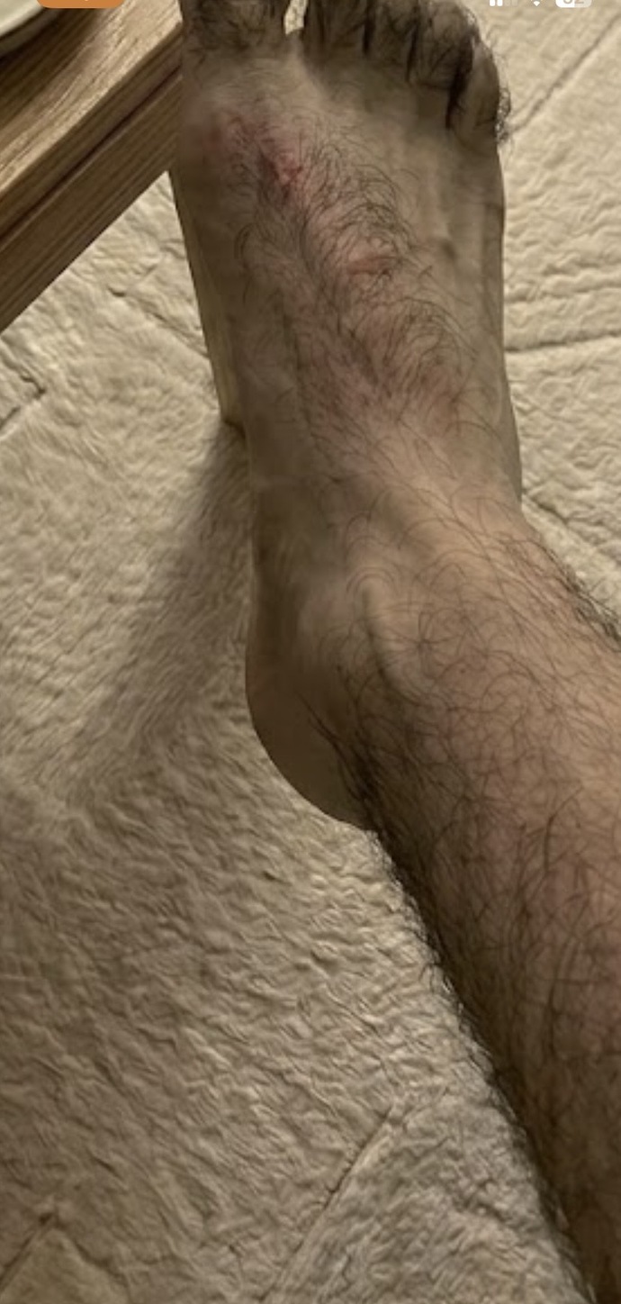 Ayağımda böyle yara gibi bir şey çıktı neden olabilir?