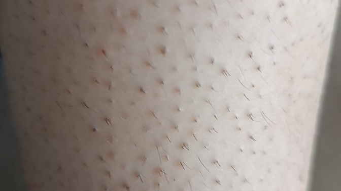 Lazer epilasyon sonrası bacağımda gelişme var mı, nasıl görünüyor?