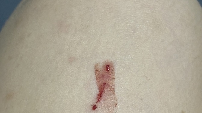 Köpeğin tınak izi kalir mi?