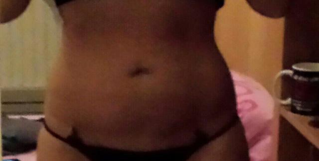 Liposuction yaptırcam randevu aldım?