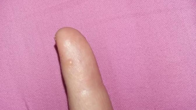 Ellerimde parmaklarımda böyle minik minik şeyler çıktı ne olabilir?