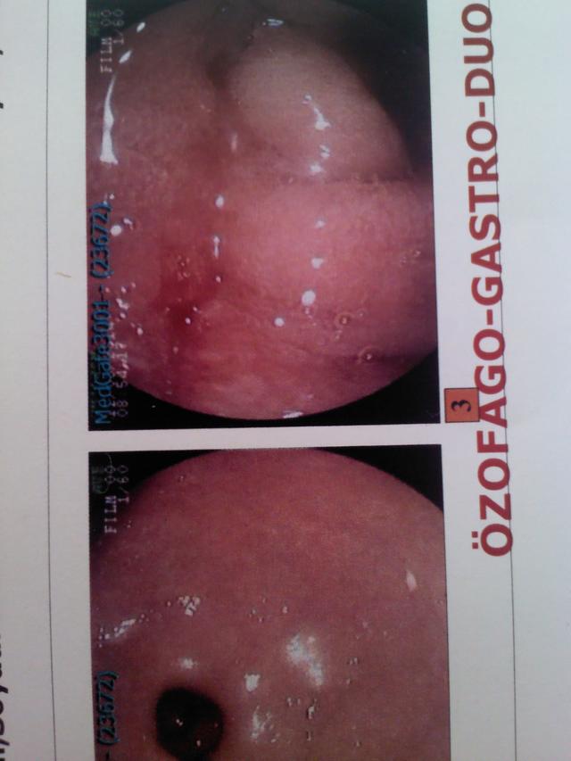 endoskopi sonucum RESİMLİ ?