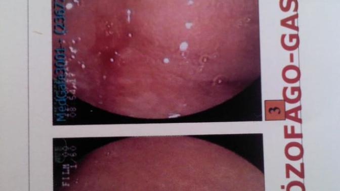 Endoskopi sonucum RESİMLİ?
