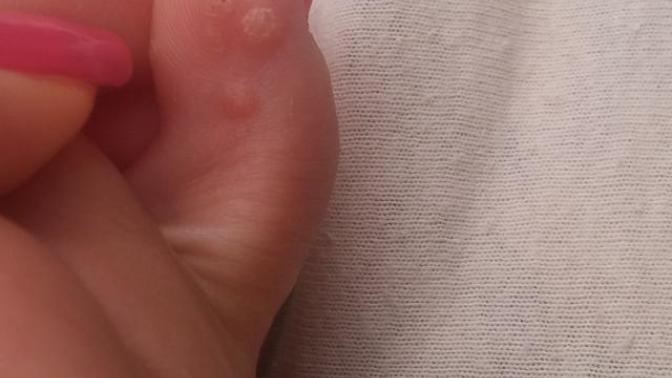 Bakar misiniz? Nasırmıdır? Yoksa cinsel bir hastalik belirtisi  falan  mi?