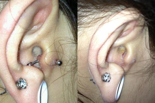 Aranızda piercing kullanıp keloide (et büyümesi) yakalanan var mı?