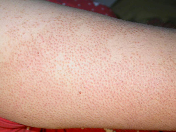 Tavuk Derisi (Keratosis Pilaris) Hastalığı?