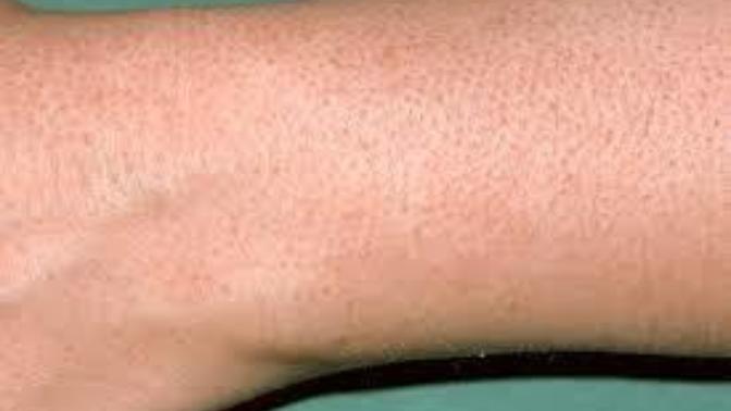 Tavuk Derisi (Keratosis Pilaris) Hastalığı?