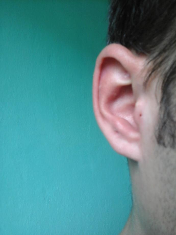 Kulağımın kıkırdak yani üst kısmındaki piercingi keloid nedeniyle çıkardım. Ama hafif bir şişlik var. Bu şişkinlik hiç gitmeyecekmi?
