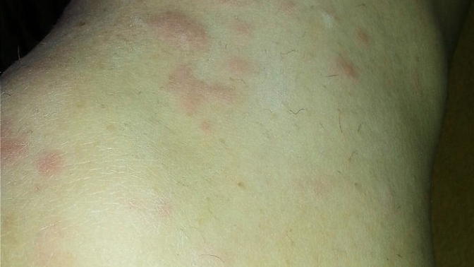 Bacağımda ve kollarimdaki kirmizi kabarciklar? Resimli?