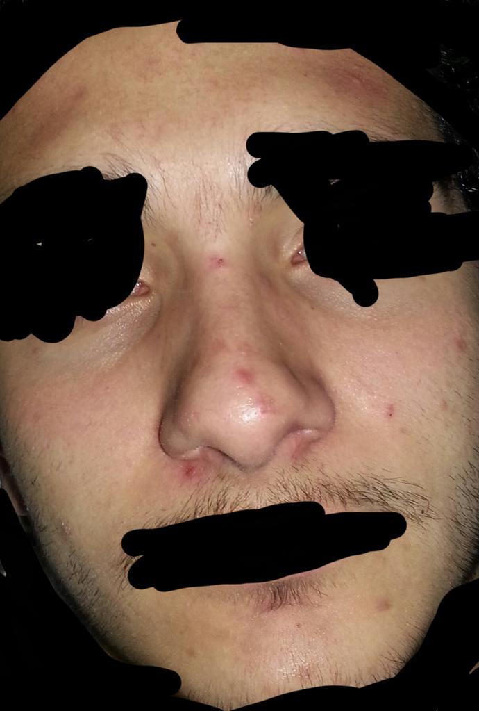 Sivilce izlerim geçer mi?