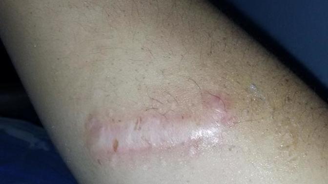 Yara izi geçmedi doktor tedavisi yok diyor?