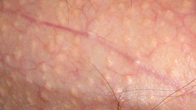 Fordyce Spots Nedir?