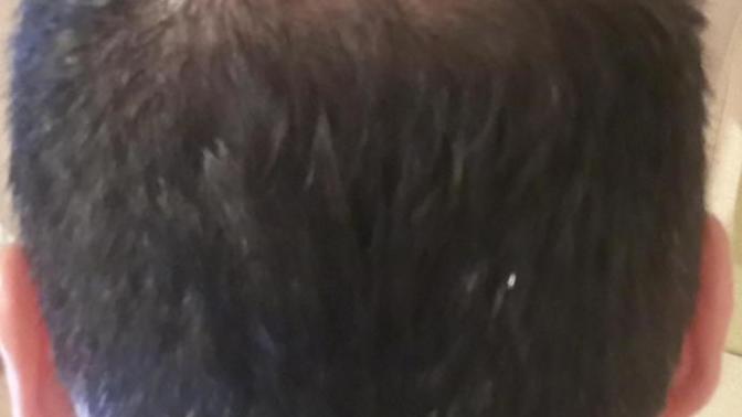 Benim Gibi Saçı Dökülen Varmı?